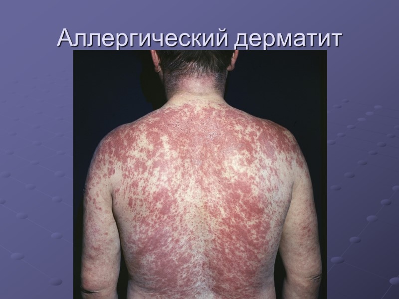 Аллергический дерматит